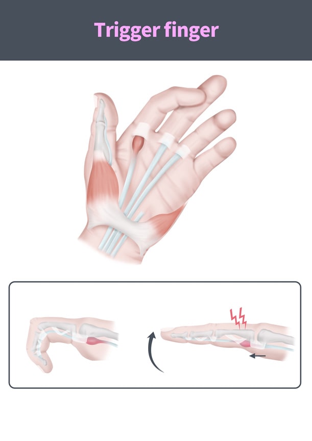 The Dreaded Golf Trigger Finger Injury - Put a Stop to It Now 