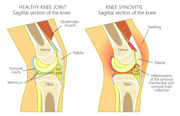 What Causes Lateral Knee Pain?